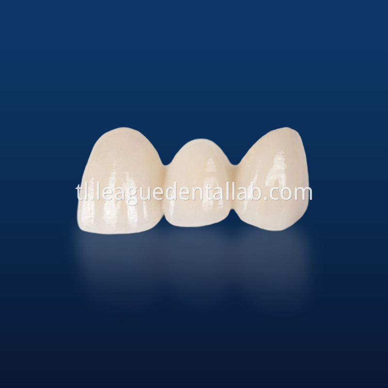 PFM,Metal crown,Fixed metal crown